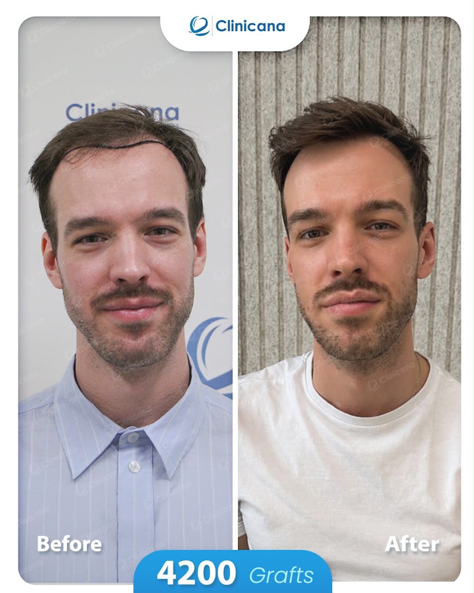 Clinicana Hair Transplant & Esthetic Surgeries in Istanbul