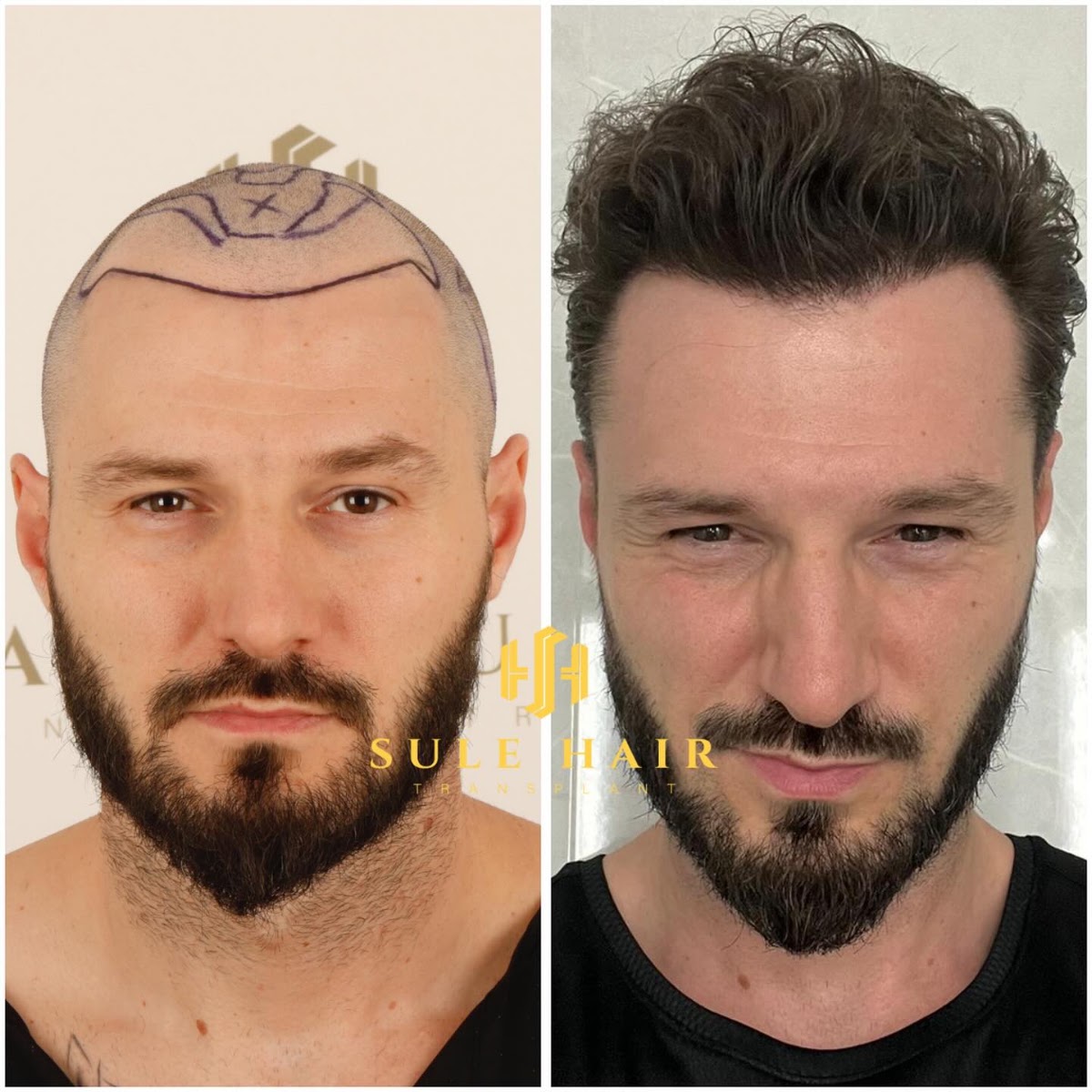 Sule Hair Transplant: Hair Transplant Turkey hair transplant clinic in Istanbul