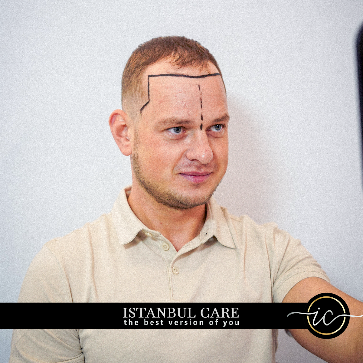 Istanbul Care | Hair Transplant Turkey in Istanbul